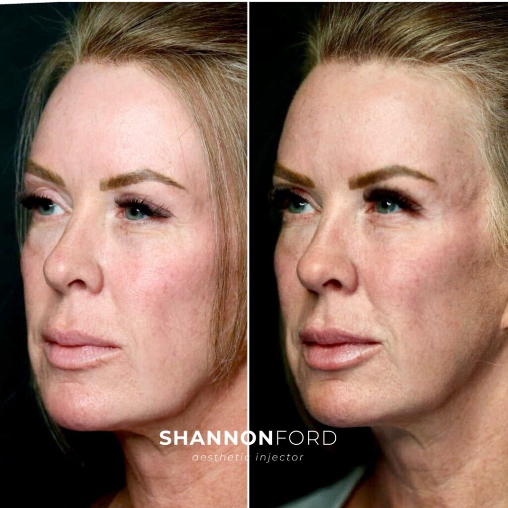 Copy of How much filler and botox do you think was used for this refresh_ - 4